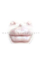 Caterpillarplasty