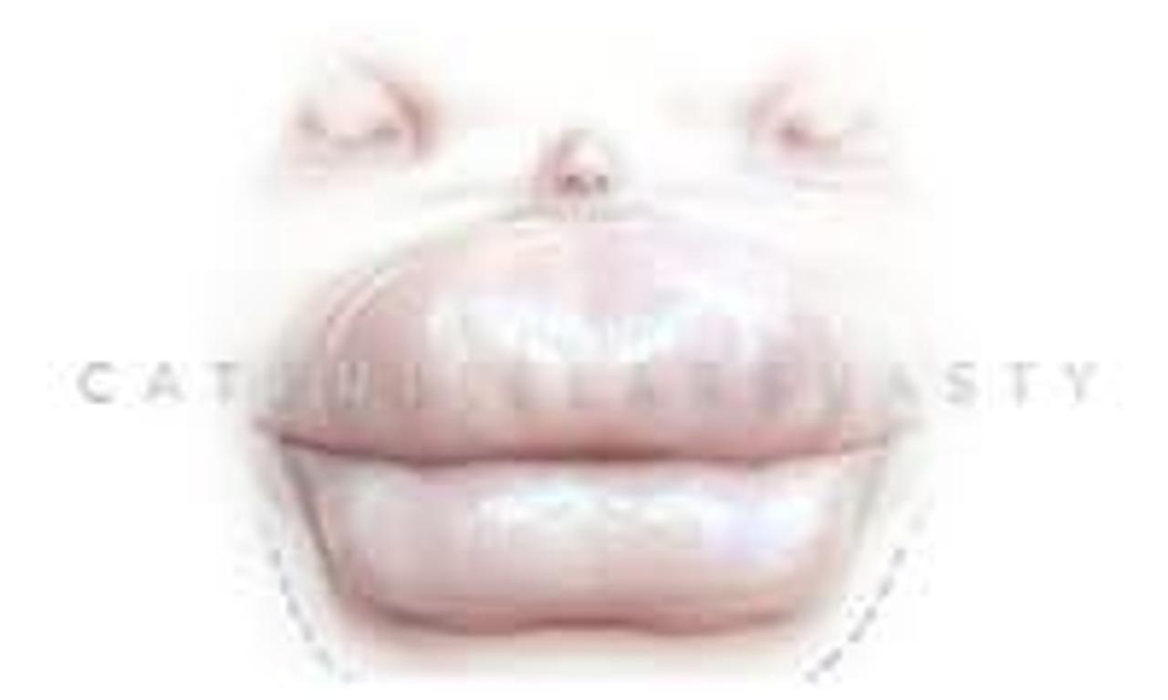 header image for Caterpillarplasty