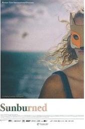 Sunburned