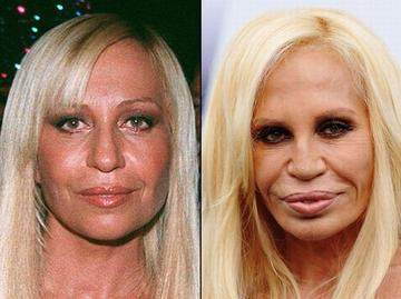 Celebrities Best and Worst Surgery